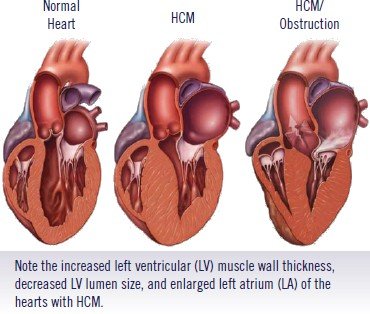 hypertrophic cardiomyopathy